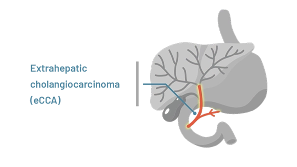 A graphic representing extraheptic cholangiocarcinoma.