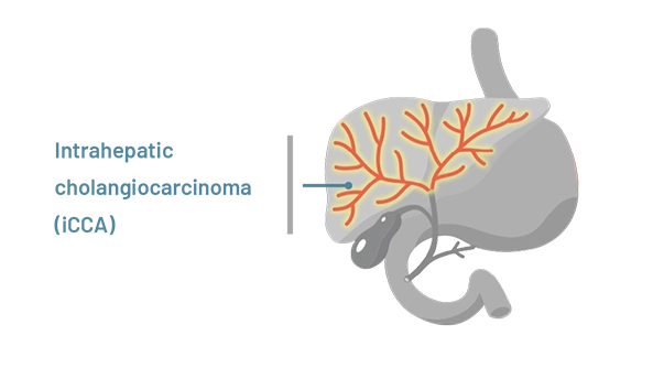 A graphic representing intraheptic cholangiocarcinoma.