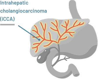 A graphic representing intraheptic cholangiocarcinoma.